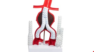 Health Education Instructions after Aortic Stent Graft Placement 主動脈支架置入術後衛教說明