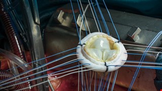 Health Education Instructions After Prosthetic Valve Replacement 人工瓣膜術後衛教說明