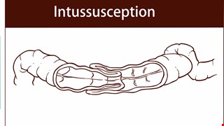 Intussusception 腸套疊