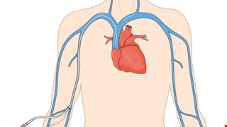 Ống Thông Tĩnh Mạch Trung Tâm Tiêm Vào Xung Quanh (PICC) Thay Thuốc Và Chăm Sóc Tại Nhà 週邊置入中心靜脈導管(PICC)換藥與居家照護(越南文)