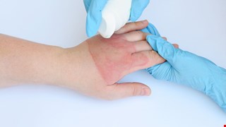 Burn Injury Wound Treatment Process 燒燙傷傷口的處理