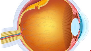 What is the cause of Retinal Detachment? 為什麼會視網膜剝離？