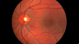 Rhegmatogenous Retinal Detachment 裂孔性視網膜剝離