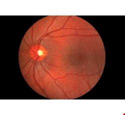Rhegmatogenous Retinal Detachment 裂孔性視網膜剝離