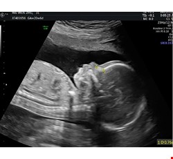 胎兒高層次超音波＆健保超音波比較表