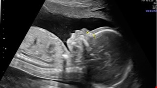 Comparison Chart between Level II Ultrasound & NHI Gynecologic Ultrasound 胎兒高層次超音波＆健保超音波比較表