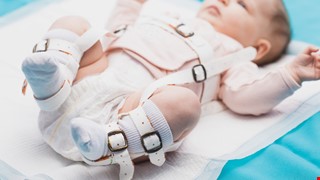 Developmental Dysplasia of the Hip (DDH) 發展性髖關節發育不良