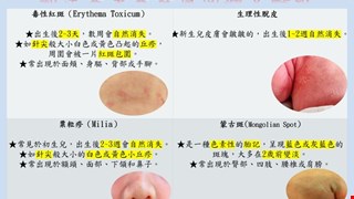 新生兒常見皮膚問題大解析/BR