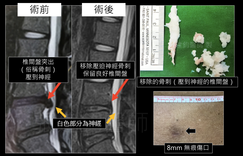 張建鈞醫師|電腦導航微創脊椎手術 電腦導航微創脊椎手術