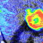 四維電腦斷層 精確瞄準胸腔及肝臟腫瘤