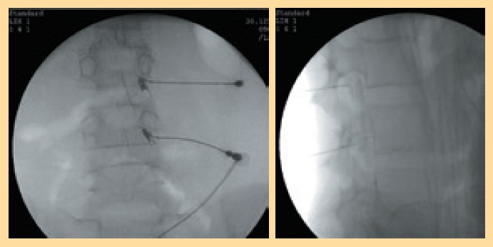 經椎間孔背根神經節介入性治療（圖3）