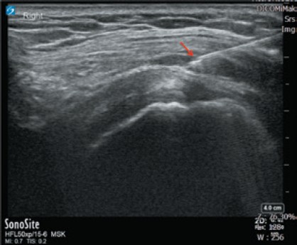 圖1： 肩峰下滑囊類固醇注射，在超音波定位下注射，可清楚辨識針與結構的關係。