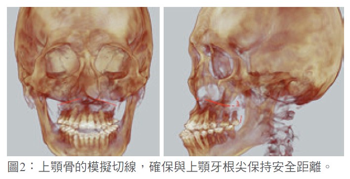 圖2：上顎骨的模擬切線，確保與上顎牙根尖保持安全距離。