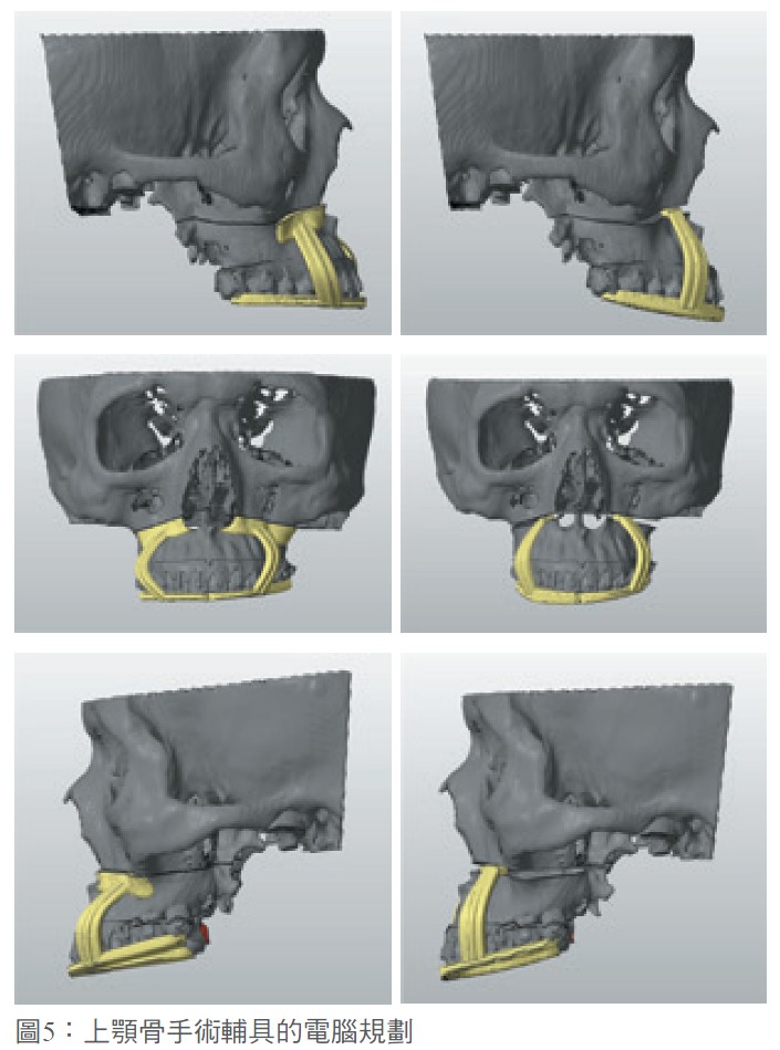 圖5：上顎骨手術輔具的電腦規劃