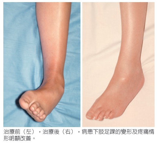 治療前（左），治療後（右），病患下肢足踝的變形及疼痛情形明顯改善。