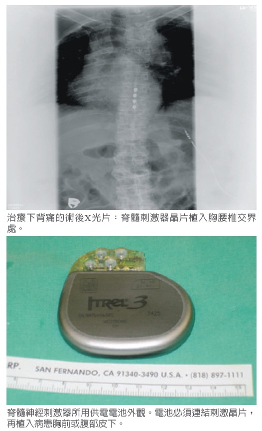 治療下背痛的術後X光片：脊髓刺激器晶片植入胸腰椎交界處。