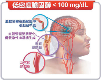 圖2：梗塞型腦中風患者低密度膽固醇指引