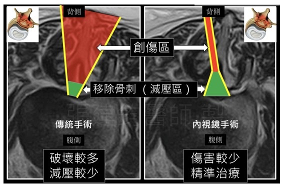 微創脊椎手術新選擇：脊椎內視鏡手術演進和介紹