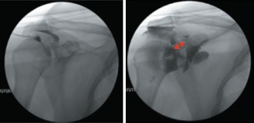圖2： 沾黏的肩關節囊擴張前（左）後（右），可見肩關節囊已明顯變大（箭頭）。