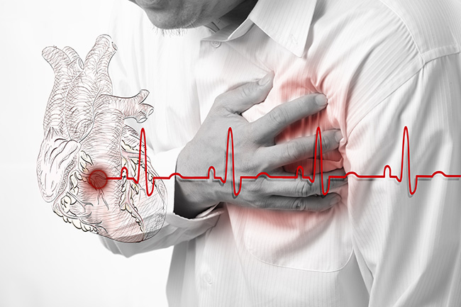 急性心肌梗塞的典型症狀包括虛弱、發 汗、暈眩、嘔吐、心跳不穩定等，病患常表示 就好像被大石頭壓住胸口一樣的悶痛。
