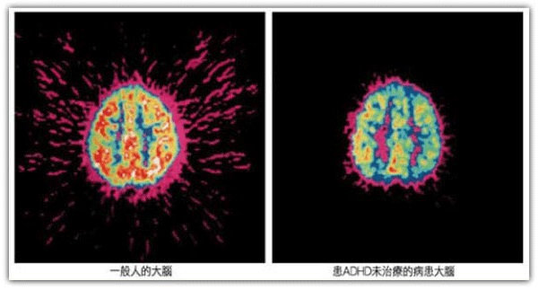 一般成人大腦( 左) 與患有ADHD 卻從未接受治療的大腦( 右)有所不同