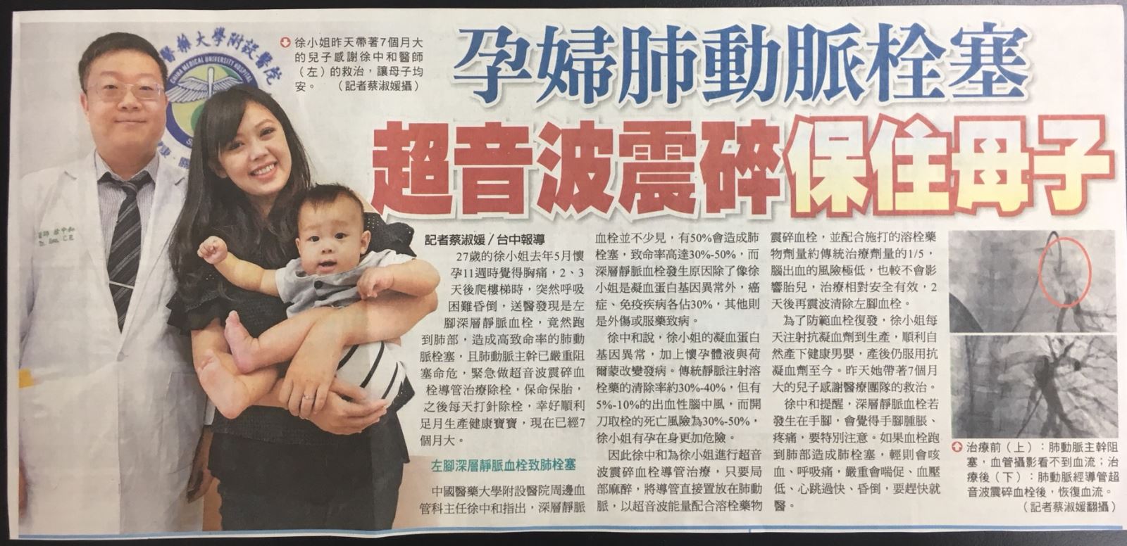 新一代溶栓術 超音波震碎血栓導管治療 及時打通急性血管阻塞