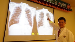 30年老菸槍患肺腺癌 免疫療法1月腫瘤消