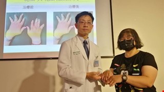 這病讓她手變形腫成「香腸指」 輕碰就痛、扣釦子也無法！