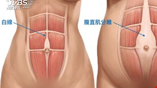 產後腰酸背痛「腹直肌分離」運動、開刀可治