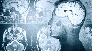 護腦顧命救神經 急性腦血管梗塞治療新趨勢