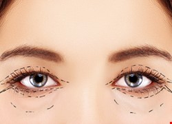 上眼瞼成形手術 美觀與功能兼具