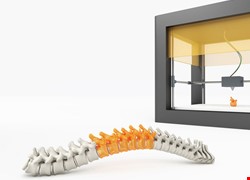 3D列印定位準 整治脊椎大利多