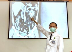 憋尿憋出鹿角狀腎結石 微創雙鏡聯合手術一次清除