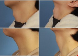 喉結手術、無疤痕喉結減積手術 (Scarless Thyroid Cartilage Reduction)