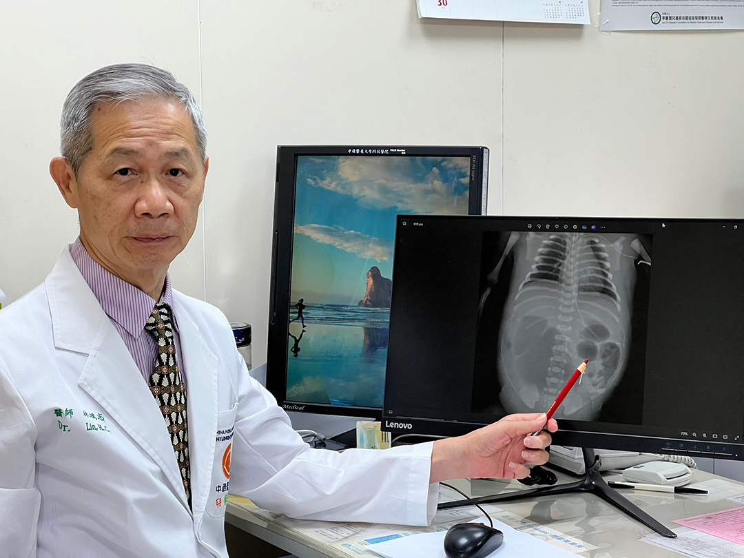 先天迴腸閉鎖、腸扭轉與嚴重穿孔 小寶貝生命垂危 中醫大附醫及兒醫跨科醫療團隊與時間賽跑 出生第二天精準手術搶救 順利康復出院