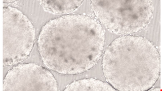 Patient-derived tumor organoids as a platform of precision treatment for malignant brain tumors