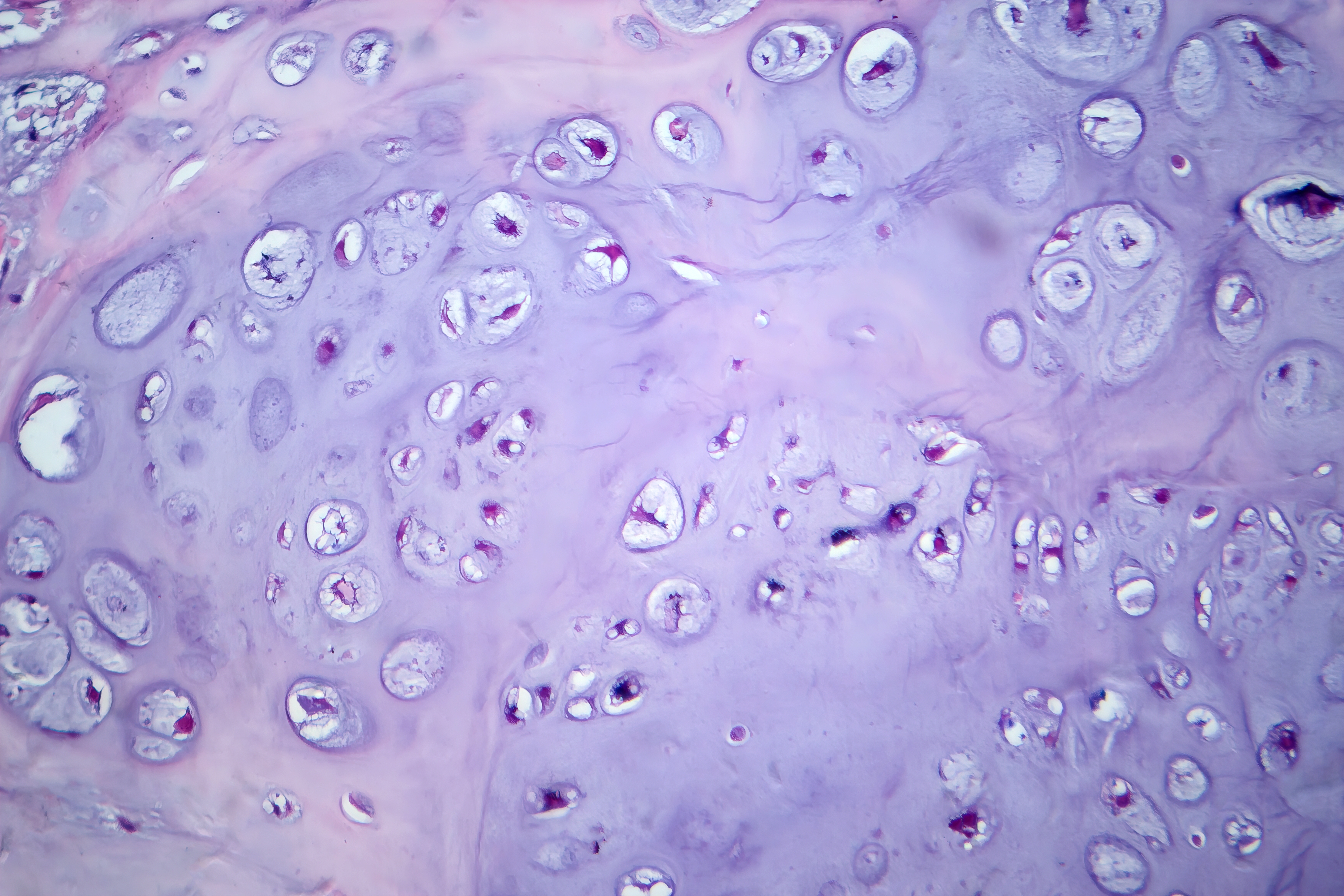 NAMPT enhances LOX expression and promotes metastasis in human chondrosarcoma cells by inhibiting miR-26b-5p synthesis