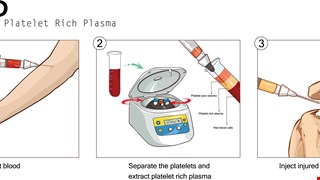 Effects of Adding Extracorporeal Shockwave Therapy (ESWT) to Platelet-Rich Plasma (PRP) among Patients with Rotator Cuff Partial Tear: A Prospective Randomized Comparative Study.