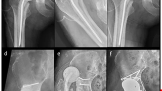 Medullary-Sparing Antibiotic Cement Articulating Spacer Reduces the Rate of Mechanical Complications in Advanced Septic Hip Arthritis: A Retrospective Cohort Study