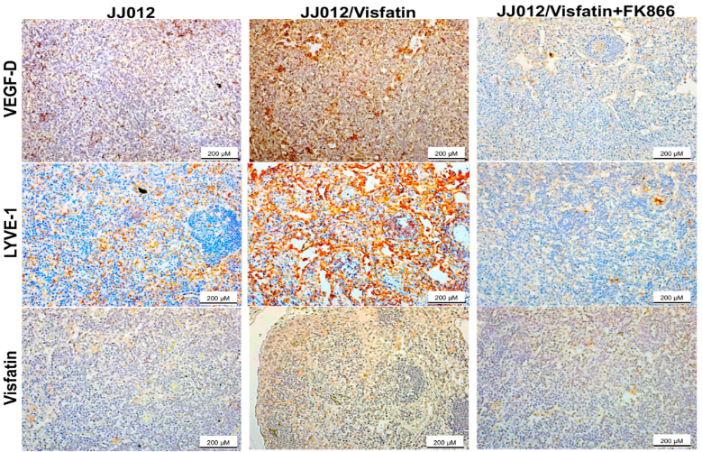 Visfatin Facilitates VEGF-D-Induced Lymphangiogenesis through Activating HIF-1α and Suppressing miR-2277-3p in Human Chondrosarcoma