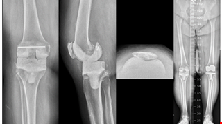 Effect of Surgeon Volume on Mechanical Complications after Resection Arthroplasty with Articulating Spacer