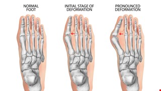 Impact of Vitamin D Receptor Genotypes on Taiwan Hallux Valgus