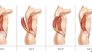 Classification of the Conjoined Latissimus Dorsi-Groin Flap and Indications for the Four Types of the Flap