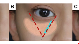 Quantitative Assessment of New Frontiers in Dermatochalasis and Periorbital Hyperpigmentation Treatment: The Role of Cross-Linked Porcine Collagen