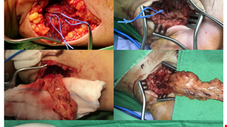 Combined double vascularized lymph node transfers and modified radical reduction with preservation of perforators for advanced stages of lymphedema