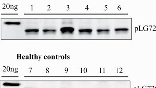 Diagnosing Alzheimer's Disease Specifically and Sensitively With pLG72 and Cystine/Glutamate Antiporter SLC7A11 AS Blood Biomarkers