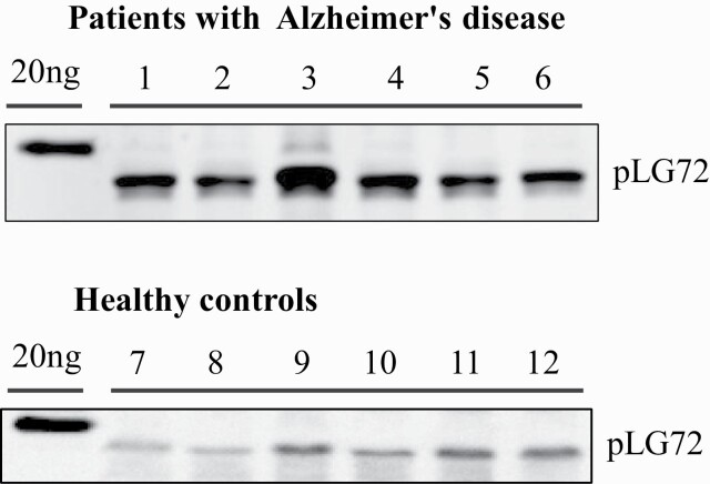 Diagnosing Alzheimer's Disease Specifically and Sensitively With pLG72 and Cystine/Glutamate Antiporter SLC7A11 AS Blood Biomarkers img