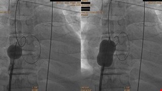 Atrial Septostomy for Left Atrial Decompression During Extracorporeal Membrane Oxygenation by Inoue Balloon Catheter