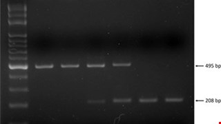 Matrix metalloproteinase 1 1G/2G gene polymorphism is associated with acquired atrioventricular block via linking a higher serum protein level
