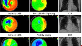 Early Experience of Patients with left Bundle Branch Block Corrected through Left Bundle Branch Area Pacing Compared with Conventional Right Ventricular Pacing: A Single-Center Retrospective Study